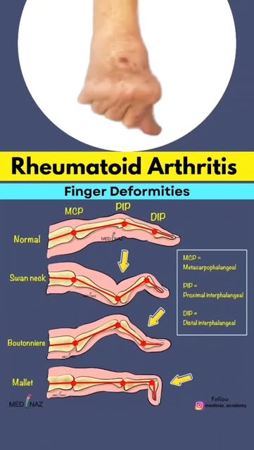 Rheumatoid Arthritis Finger Deformities
Explained | Swan Ne