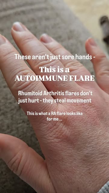 When a rheumatoid arthritis flare hits the hands, it’s not j