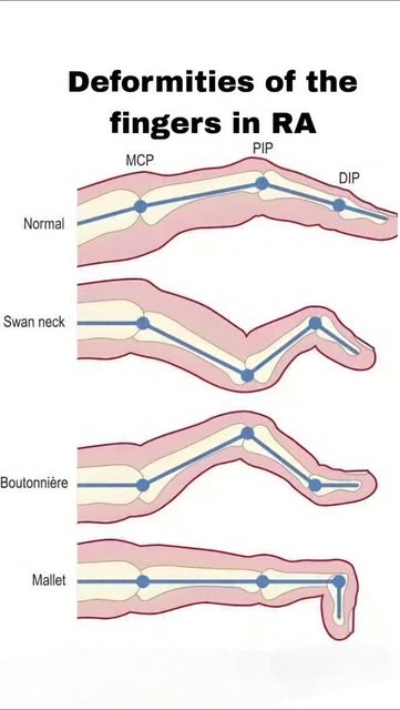 Finger Deformities in Rheumatoid Arthritis: More Than Just B