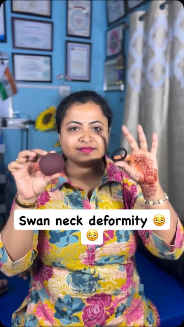 Swan neck deformity
⚠️ ଲକ୍ଷଣ (Symptoms)
• ଆଙ୍ଗୁଠିର ଆକ