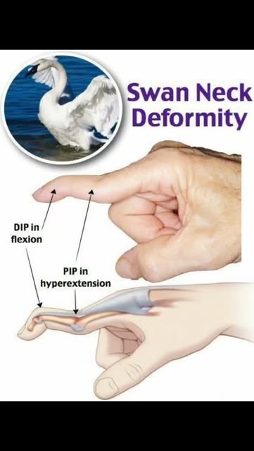 🦢 Swan Neck Deformity – تشوه رقبة البجعة
"مو كل انثناء بال