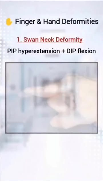 A quick guide to common hand deformities in practice
1. Swa